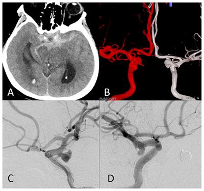 Hemodynamic and Morphological Parameters of Ruptured Mirror Posterior Communicating Artery Aneurysms